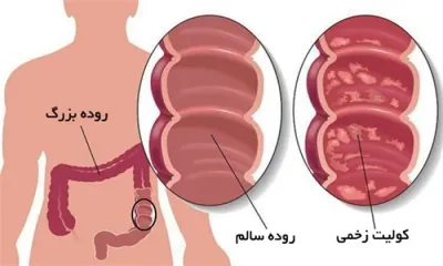 اسهال خونی
