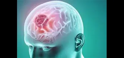 تومور مغزی